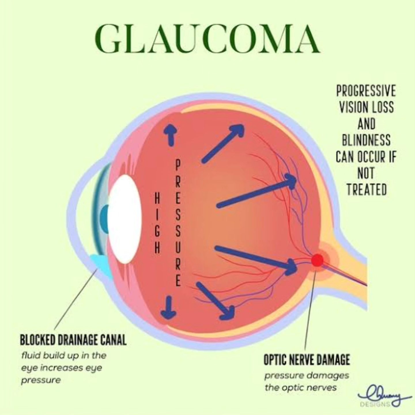 👁️ What is Glaucoma?